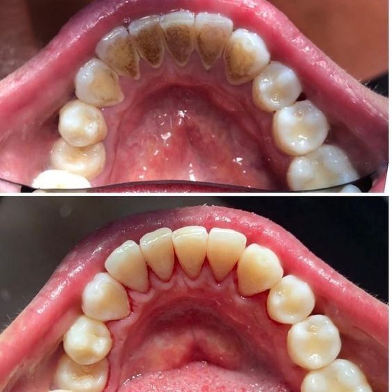 Bright clean smile after complete scaling and polishing
